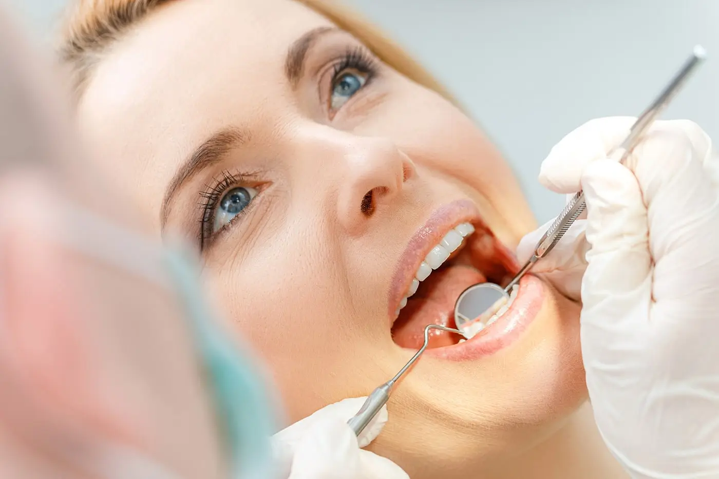Dental Sealants